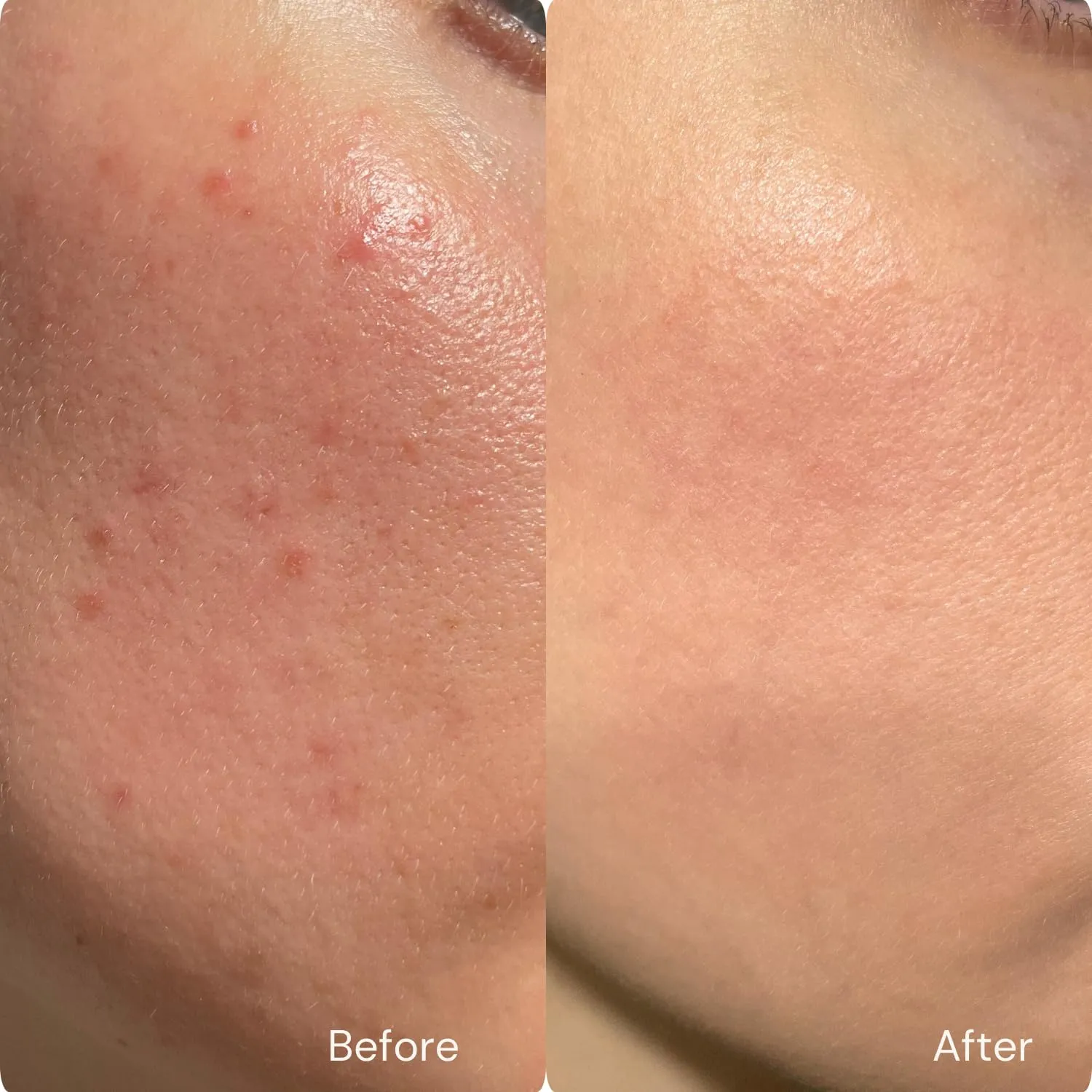 hollywoodskin 4X Strength Acne Spot Treatment | 5% Organic Salicylic Acid, 2% Niacinamide, 5% Hyaluronic Acid | Blemish Control for Acne, Blackheads, Pimples & Oily Skin | 60ml